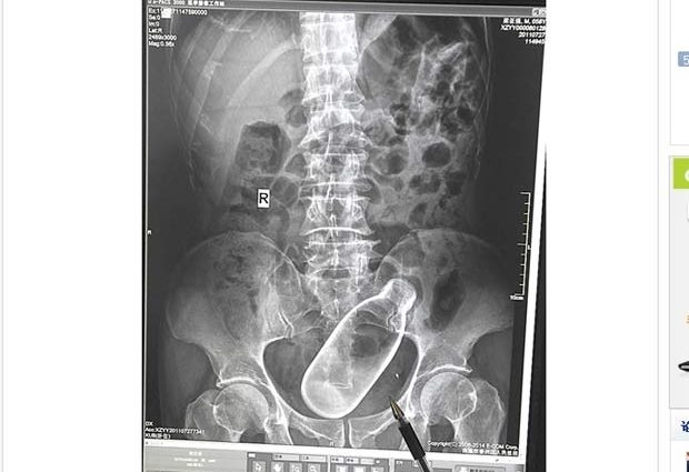 Mdico exibe raio-X que mostra a garrafa no intestino do paciente.