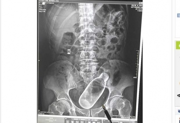Mdico exibe raio-X que mostra a garrafa no intestino do paciente. 