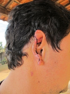 Cirurgia para reconstruo da orelha pode custar R$ 35 mil