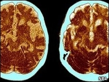 Exame mostra crebro de paciente com Alzheimer encolhendo