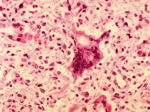 Clula infectada pelo vrus do sarampo