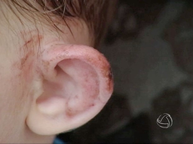 Menino teria sido mordido enquanto estava na creche, em Sinop. (Foto: Reproduo/TVCA)