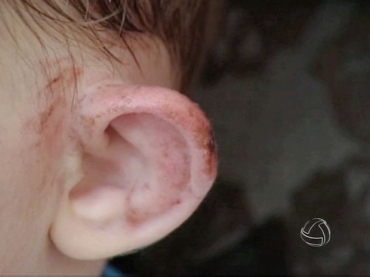 Menino teria sido mordido enquanto estava na creche, em Sinop. (Foto: Reproduo/TVCA)