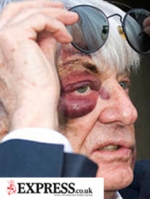 Bernie Ecclestone e o olho machucado