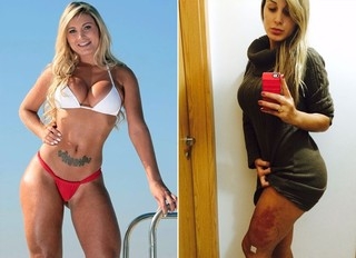 Antes e Depois: Gel na perna de Andressa Urach